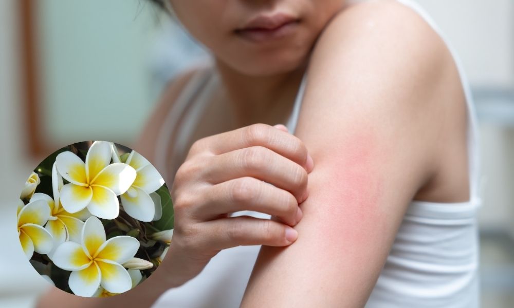 Nhựa cây hoa sứ gây dị ứng da Nhựa cây hoa sứ gây dị ứng da