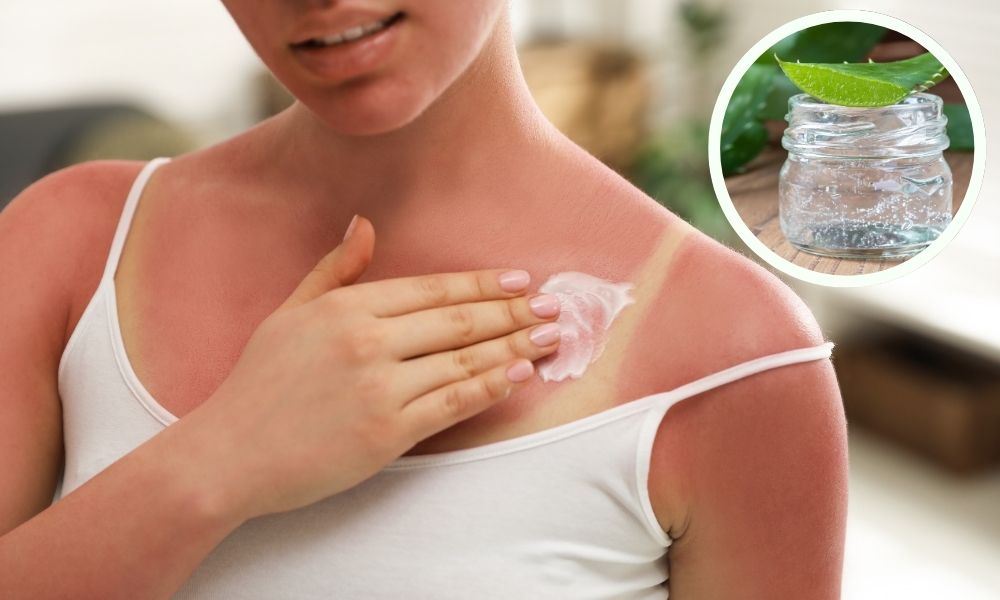 Gel nha đam giúp làm dịu da khi bị cháy nắng Gel nha đam giúp làm dịu da khi bị cháy nắng